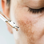 cuidados para não ter melasma