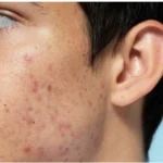 tratamentos tópicos para a acne