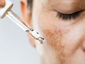 Prevenção do Melasma