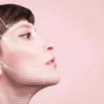 Lifting Facial Não Cirúrgico