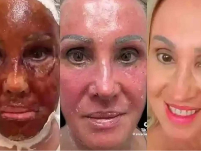 Peeling de fenol