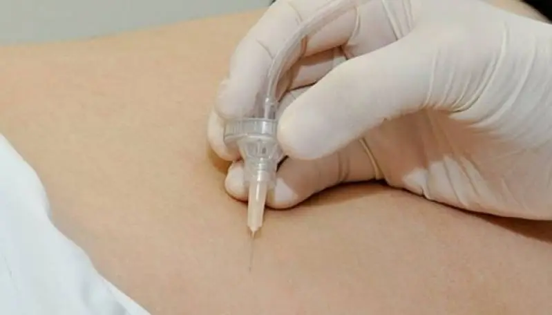 Carboxiterapia o que é