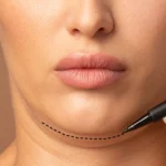 lipo-de-papada-com-enzimas
