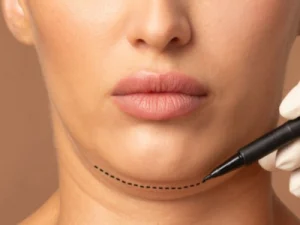 lipo-de-papada-com-enzimas
