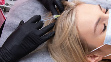 Mesoterapia Capilar