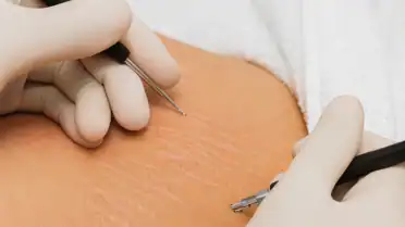 eletrolifting estrias