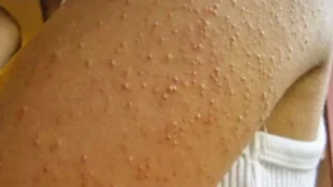 queratose pilar no braço